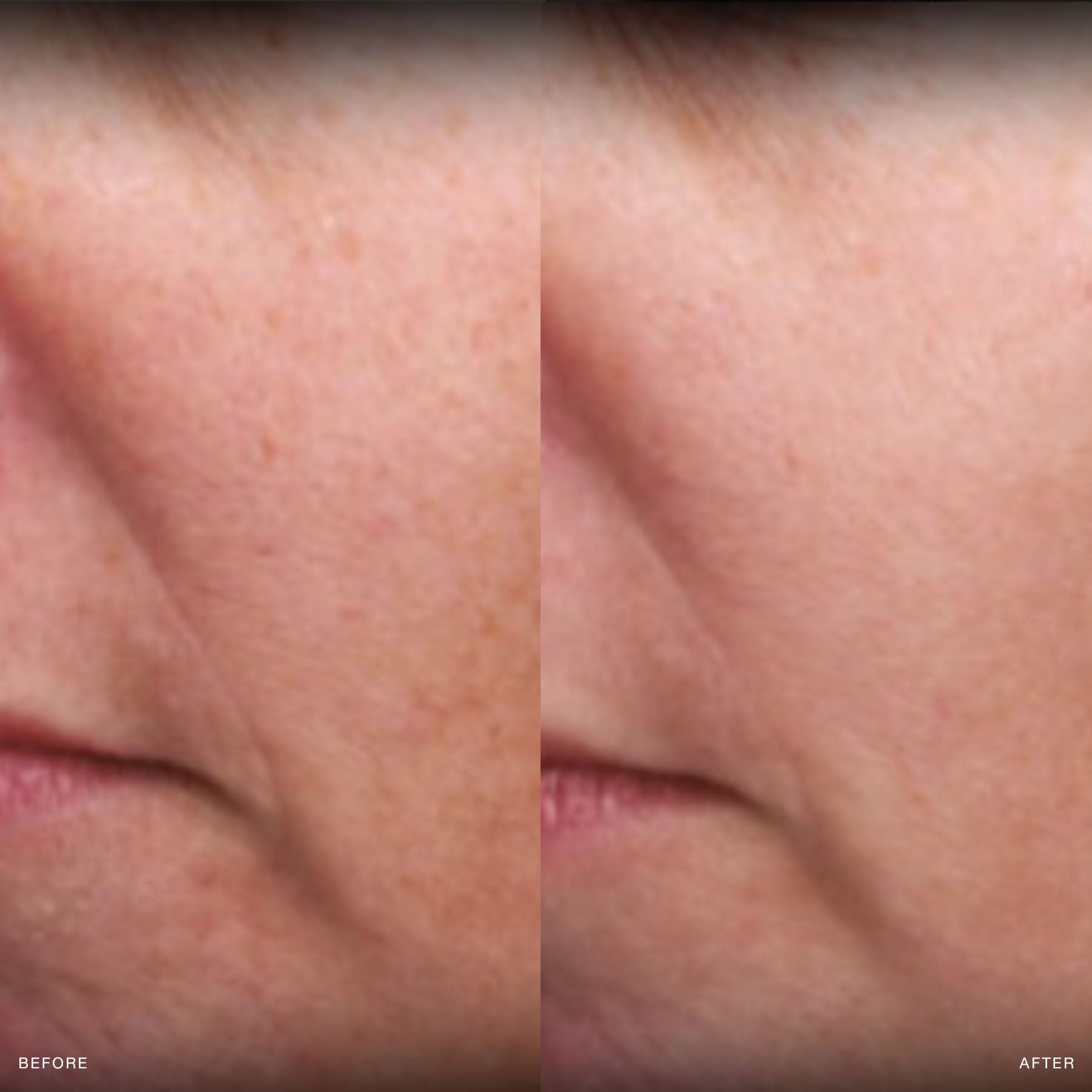 before and after moxi laser treatment