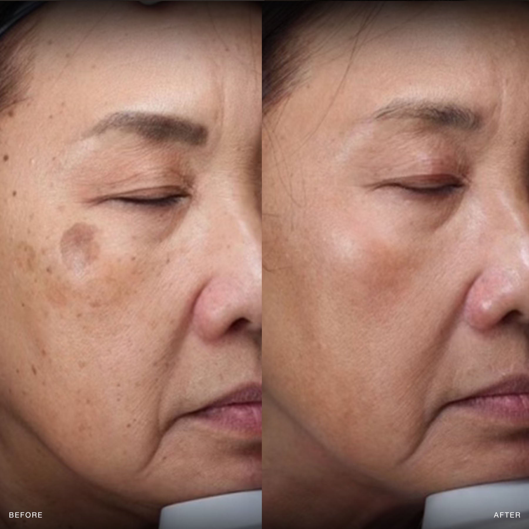 before and after moxi laser results