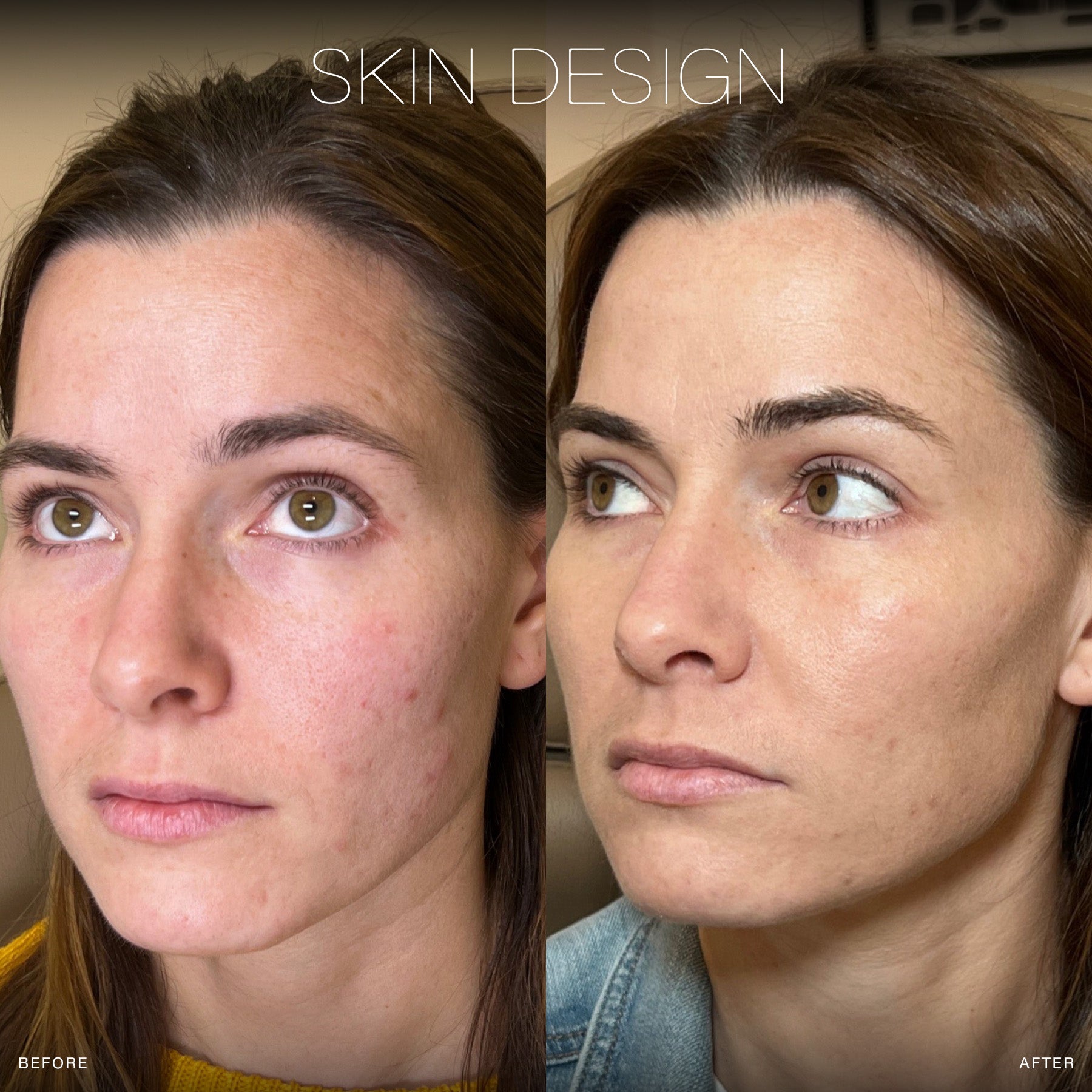 the perfect derma chemical peel before and afters skin design aesthetics medical spa