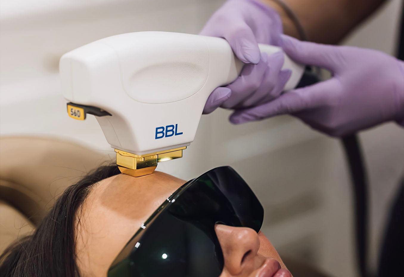 woman receiving forever young bbl photofacial performed at Skin Design Aesthetics Medical spa in South Shore, MA