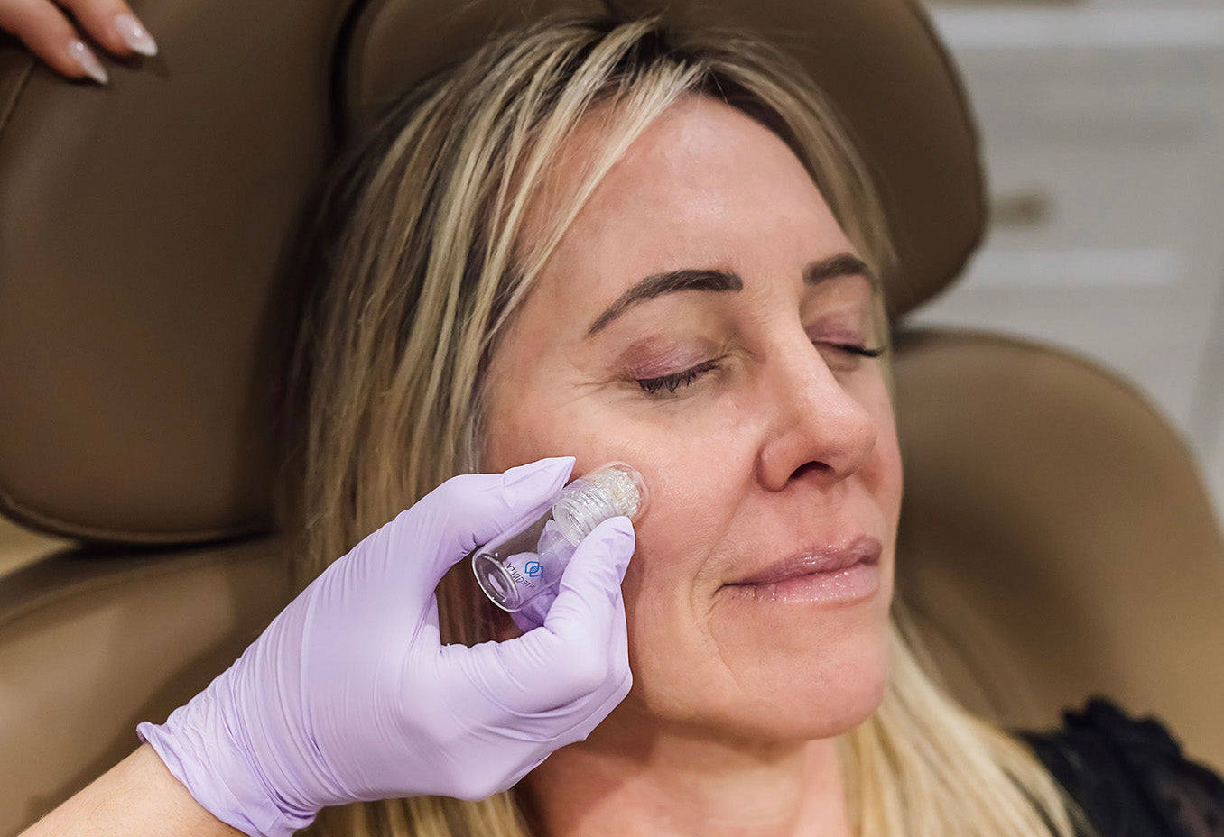 microchanneling botox facial at skin design aesthetics pembroke, ma