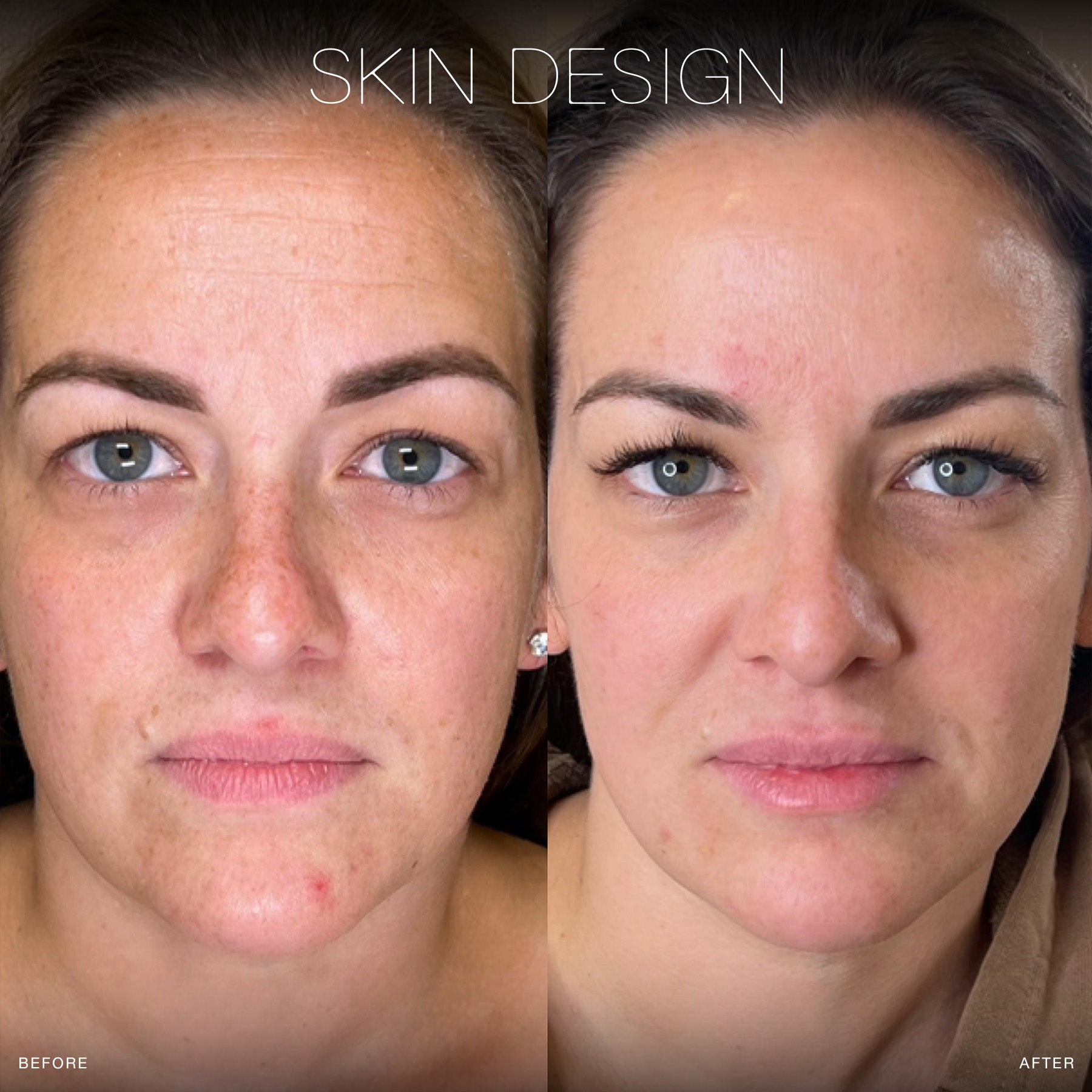 forever young bbl photofacial before and after skin design aesthetics medical spa