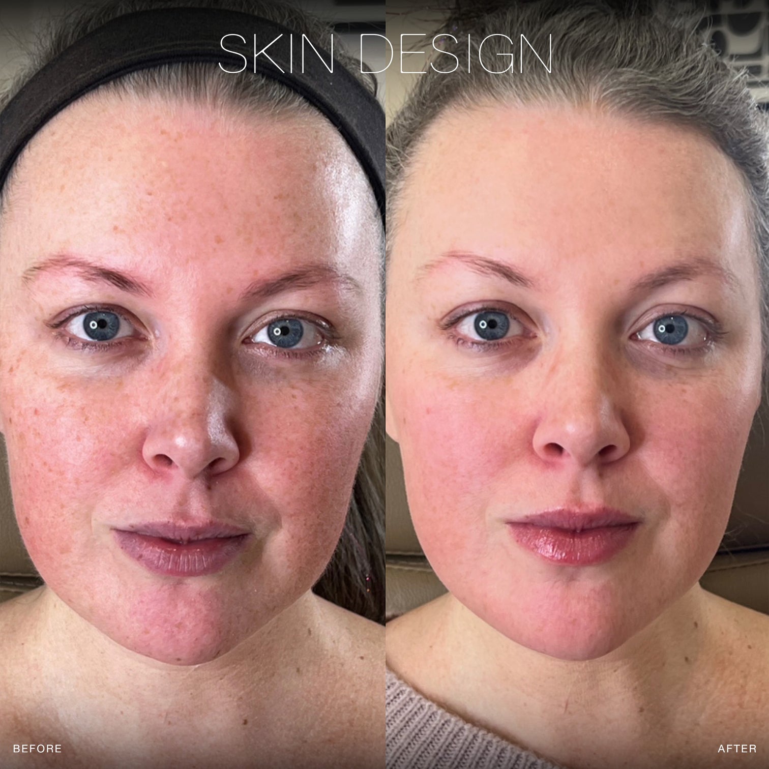 Forever Young BBL Laser Treatment Skin Design Aesthetics Med Spa in South Shore, MA Skin