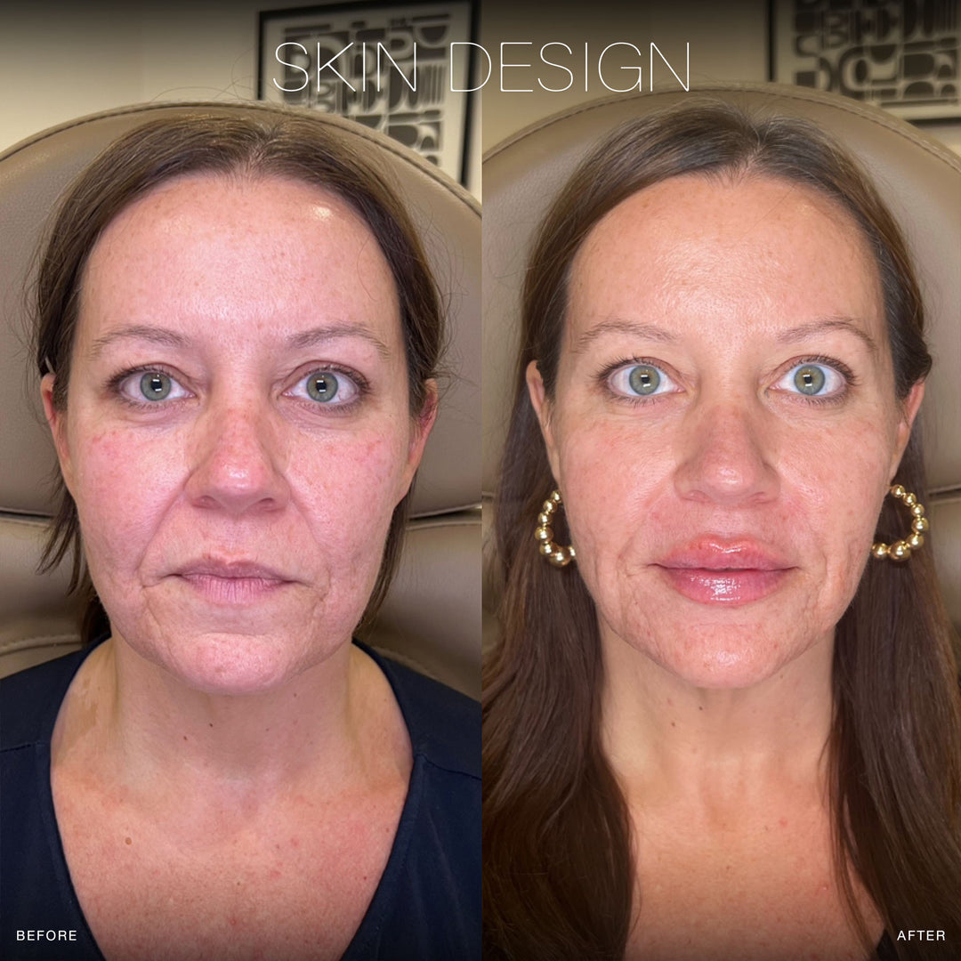 Dermal Fillers | Skin Design Aesthetics | Medical Spa in South Shore ...