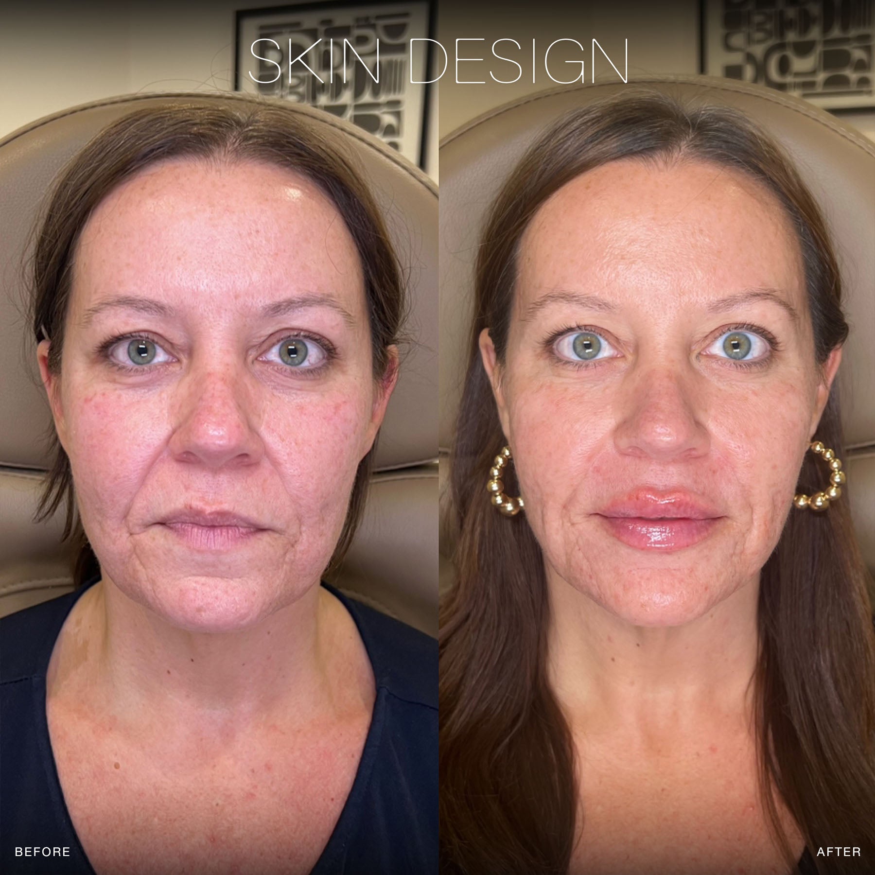 facial filler before and after results skin design aesthetics medical spa on south shore, ma