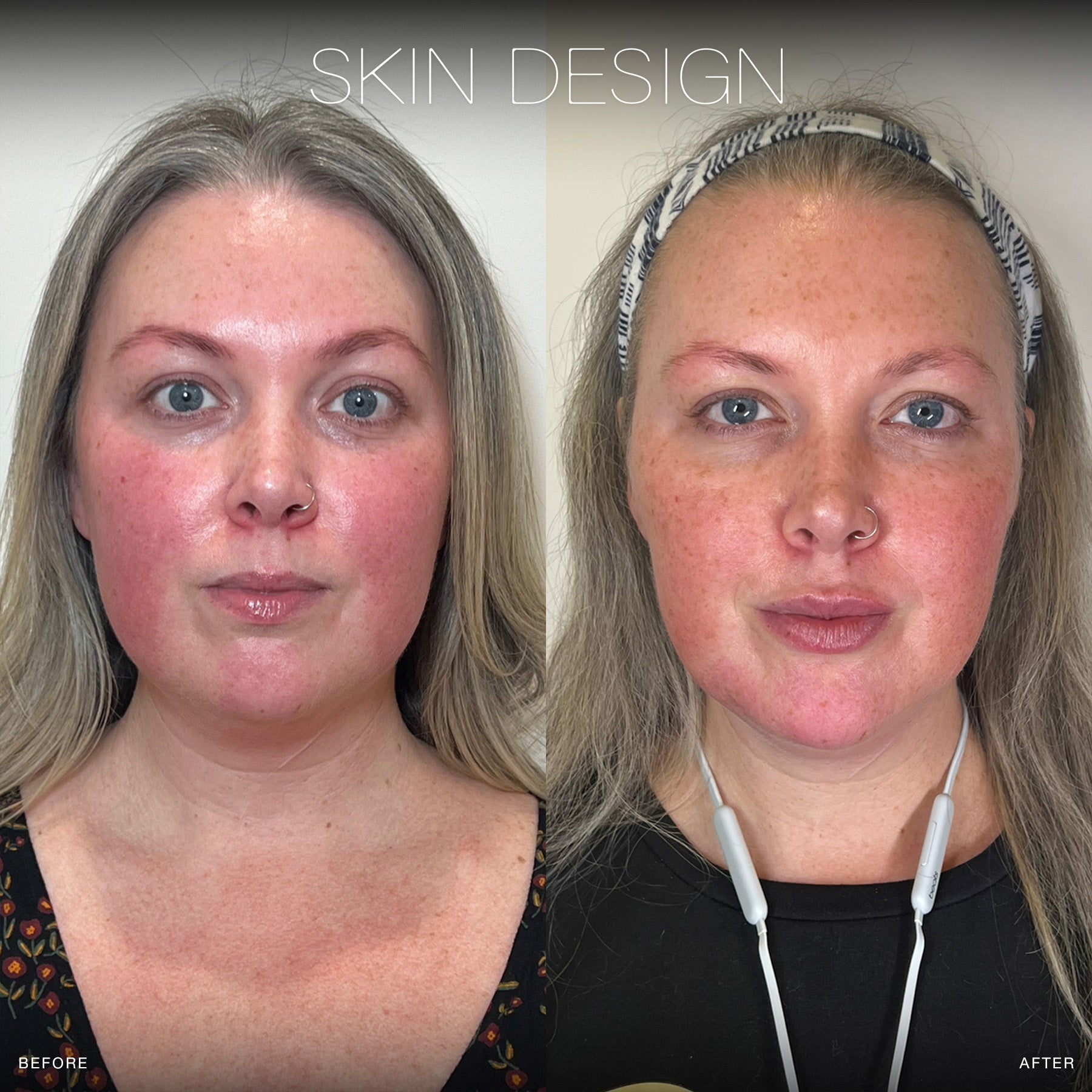 facial filler before and after results skin design aesthetics medical spa on south shore, ma