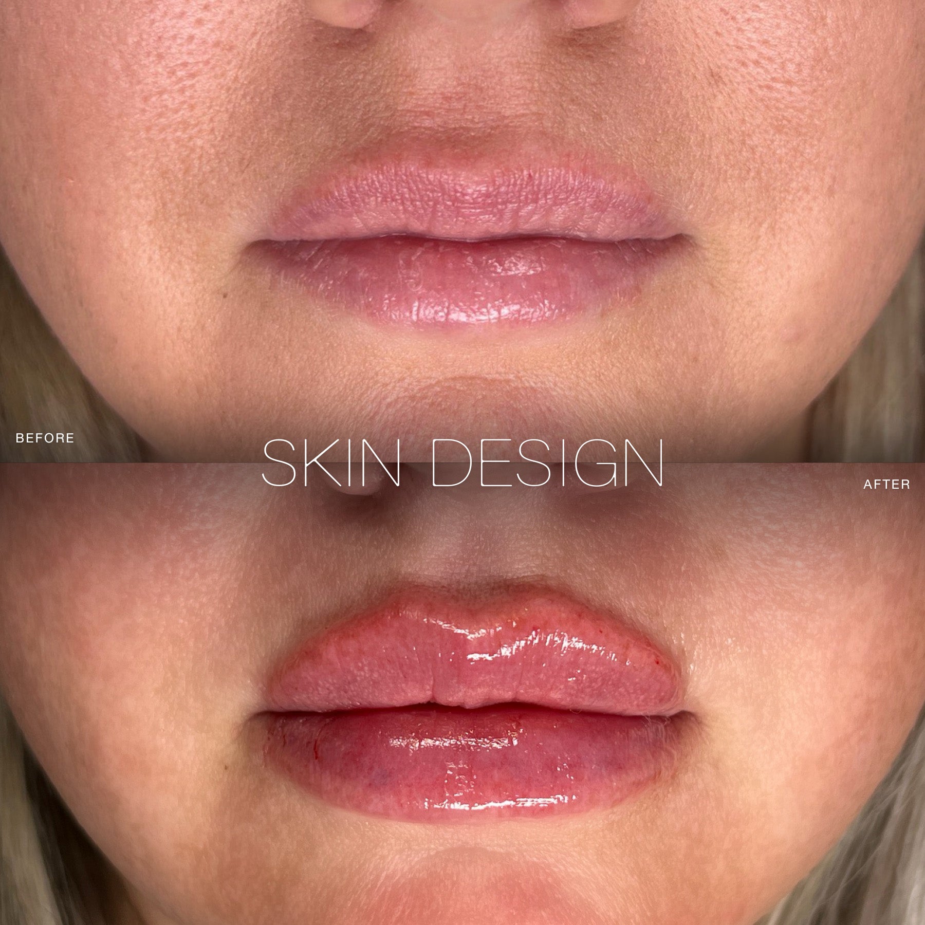 lip filler before and after skin design aesthetics medical spa south shore, ma