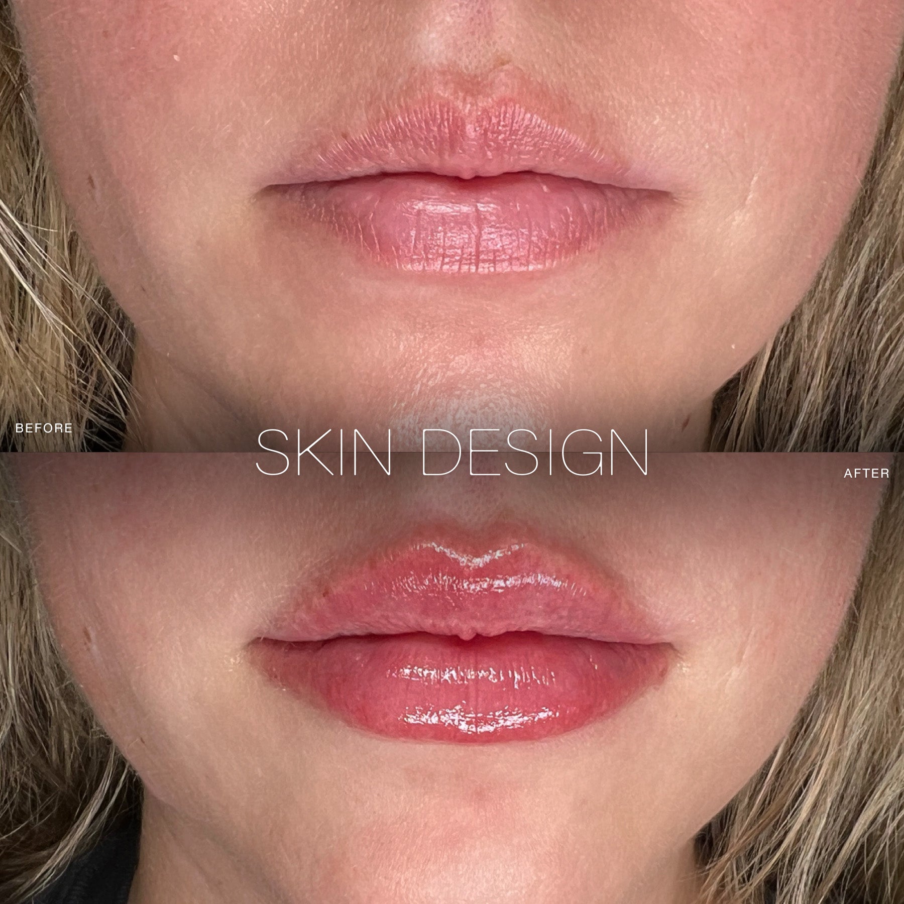 lip filler before and after skin design aesthetics medical spa south shore, ma