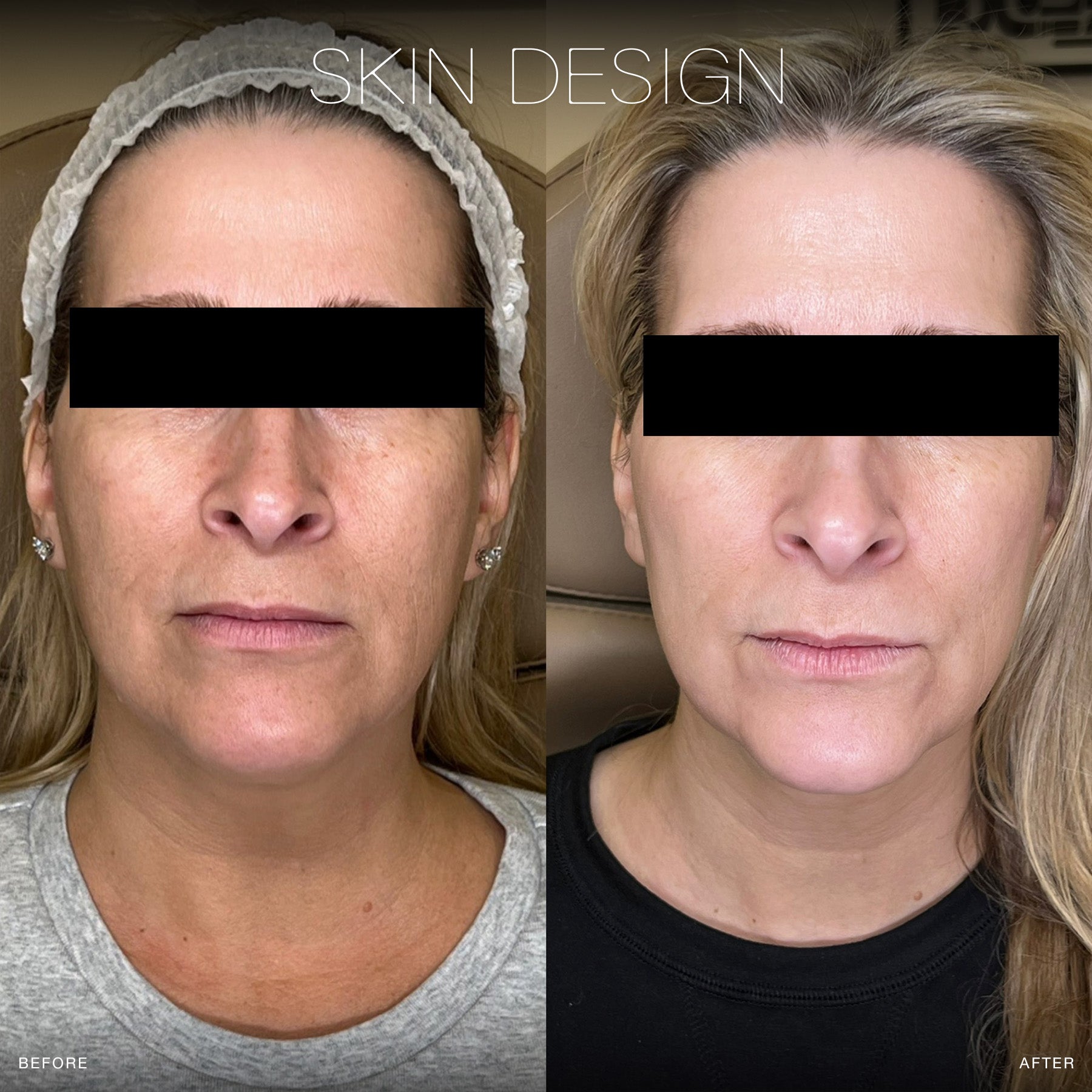 microneedling before and after results skin design aesthetics medical spa