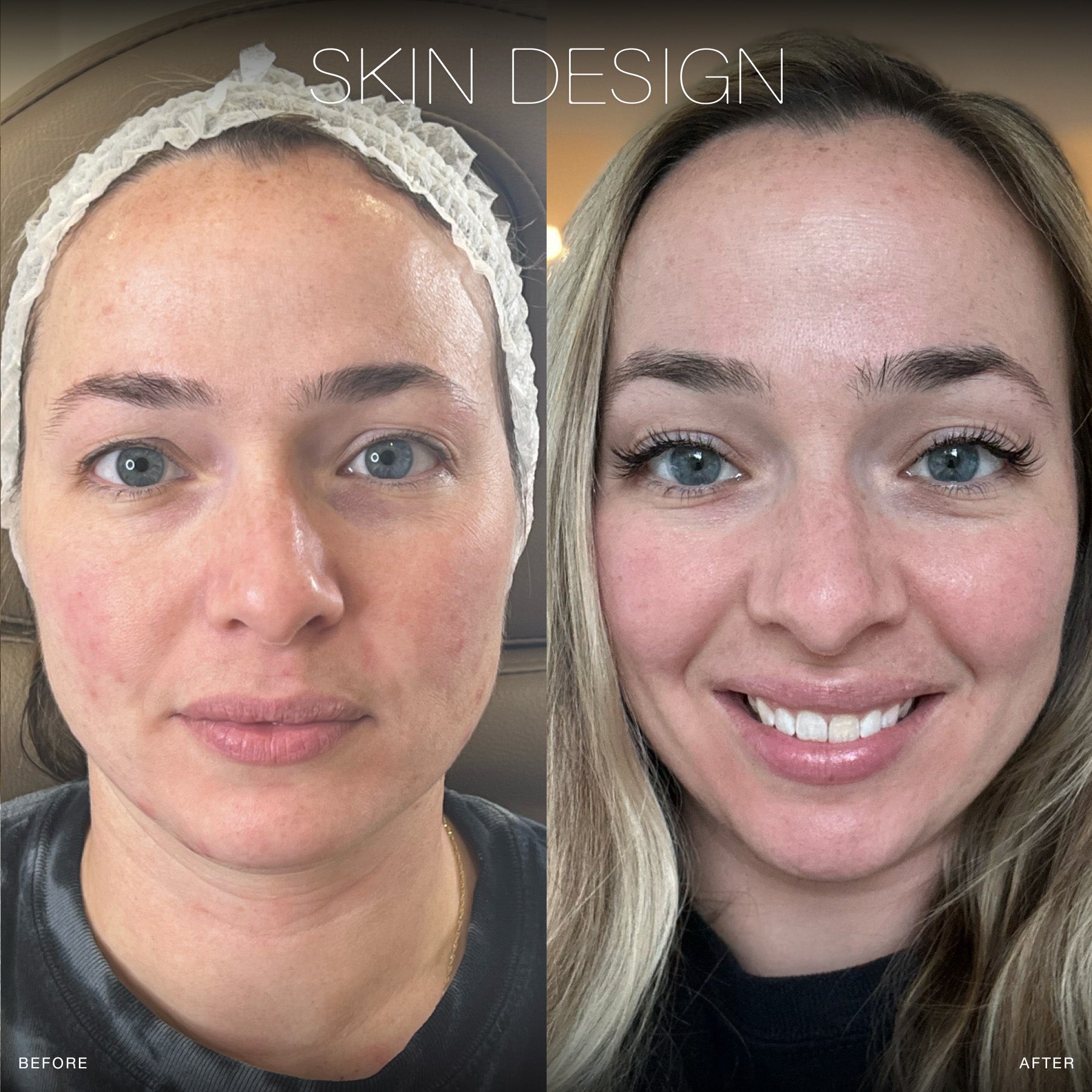 the perfect derma chemical peel before and afters skin design aesthetics medical spa