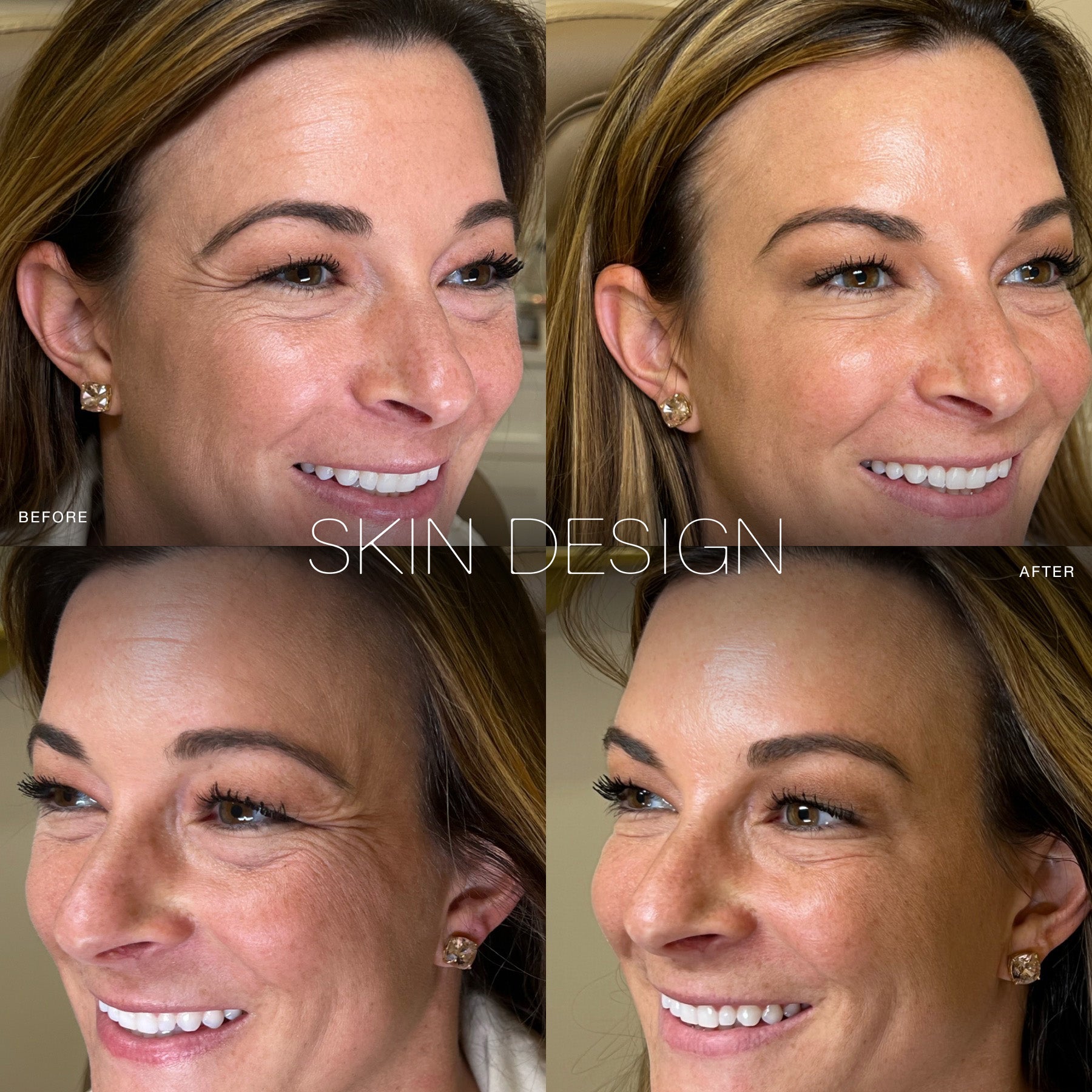 wrinkle relaxers botox dysport before and after results for forehead lines skin design aesthetics medical spa 