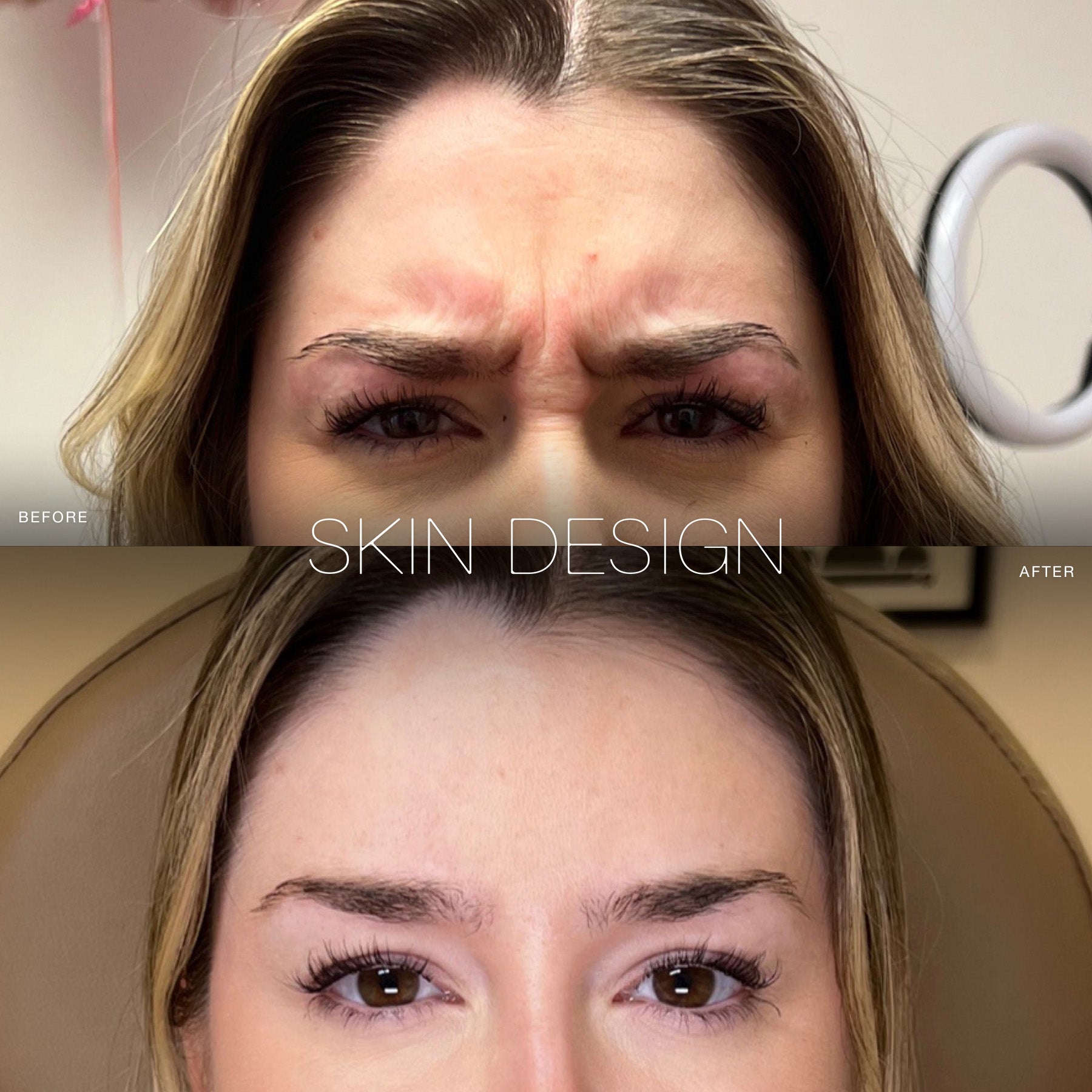 wrinkle relaxers botox dysport before and after results for forehead lines skin design aesthetics medical spa 